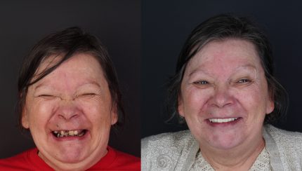 caso-clinico-digitalArch-i2-implantologia-1