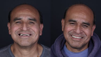 caso-clinico-digitalArch-i2-implantologia-2