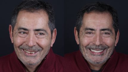 caso-clinico-digitalArch-i2-implantologia-4