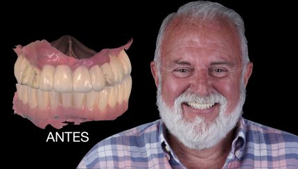 caso-clinico-digitalArch-i2-implantologia-5