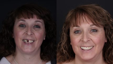 caso-clinico-digitalArch-i2-implantologia-6