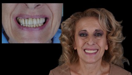 caso-clinico-protesis-en-el-dia-1