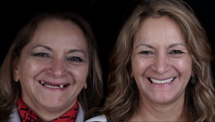 caso-clinico-protesis-en-el-dia-2