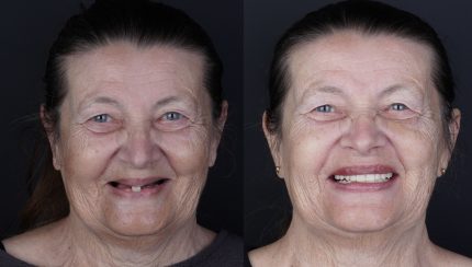 caso-clinico-protesis-en-el-dia-3