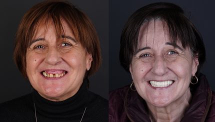 caso-clinico-protesis-en-el-dia-4