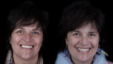 caso-clinico-protesis-en-el-dia-5