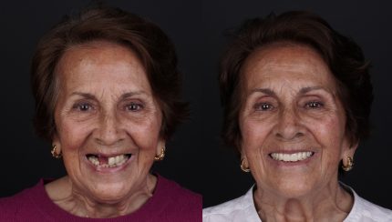 caso-clinico-protesis-en-el-dia-6