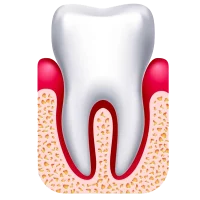 diente-con-gingivitis-i2 diente-con-gingivitis-i2