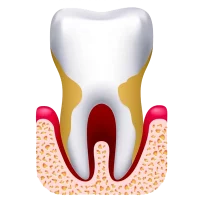 diente-con-periodontitis-i2 diente-con-periodontitis-i2